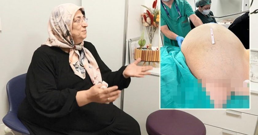 Doktorları da şaşırttı: Fobisi nedeniyle hastaneye gitmeyen kadının yumurtalıklarından 23 kiloluk kitle çıkarıldı – Son Dakika Türkiye Haberleri